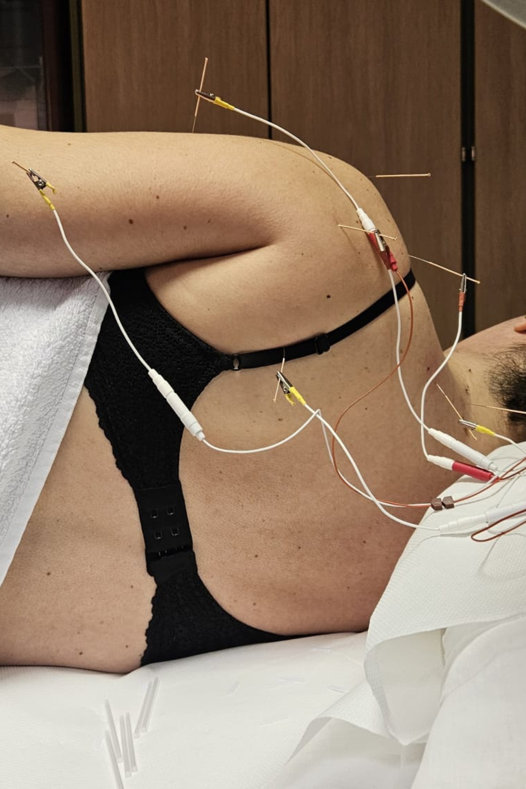 Acupuncture in wellness Balance Acupuncture services provided at Wellness Balance